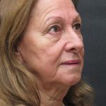 Levinelift Before & After Patient #11793