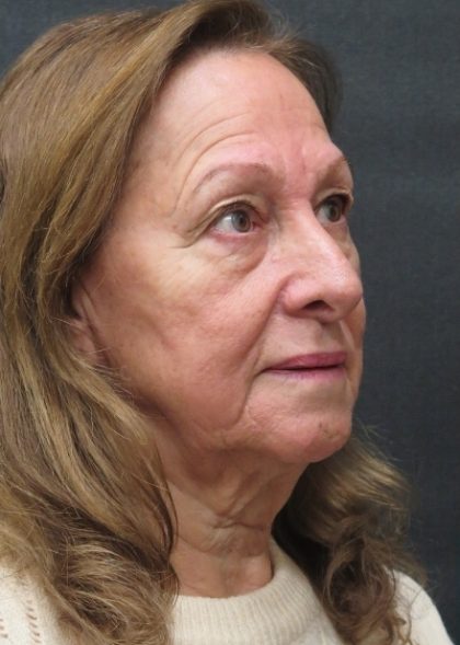 Levinelift Before & After Patient #11793