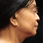 Levinelift Before & After Patient #11819