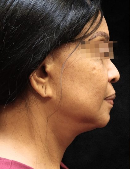 Levinelift Before & After Patient #11819