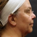 Levinelift Before & After Patient #11791