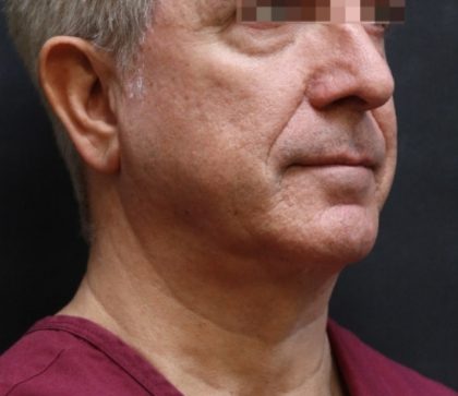 Levinelift Before & After Patient #11824