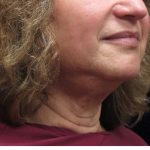 Levinelift Before & After Patient #11825