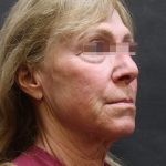 Levinelift Before & After Patient #11790