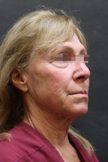 Levinelift Before & After Patient #11790