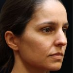 Rhinoplasty Before & After Patient #11947