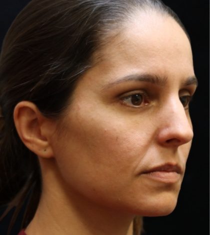 Rhinoplasty Before & After Patient #11947