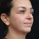 Rhinoplasty Before & After Patient #11948