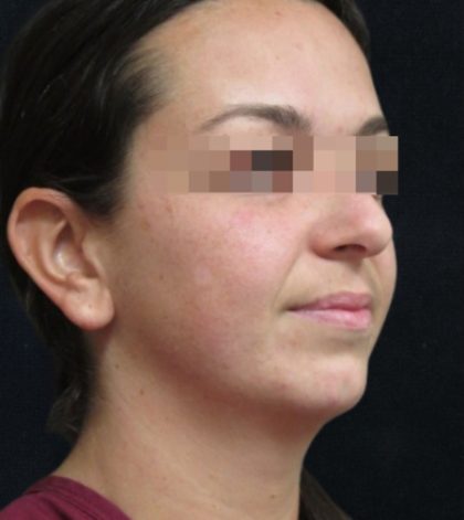 Rhinoplasty Before & After Patient #11948