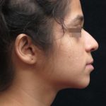 Rhinoplasty Before & After Patient #11949