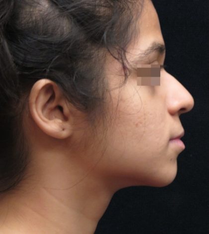 Rhinoplasty Before & After Patient #11949