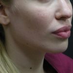 Rhinoplasty Before & After Patient #11950