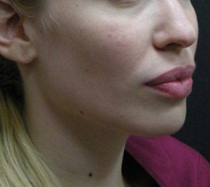 Rhinoplasty Before & After Patient #11950