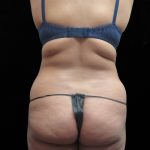 Liposuction Before & After Patient #11546