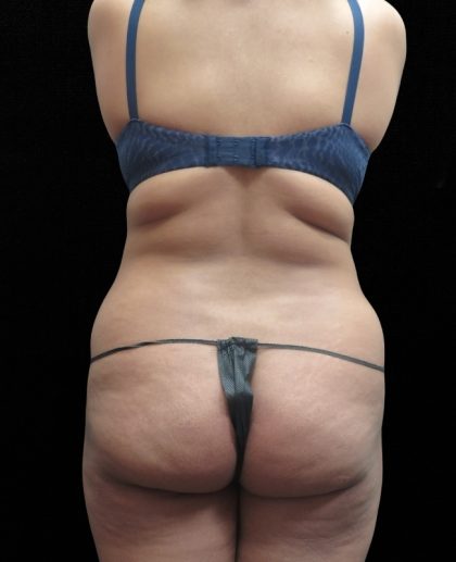 Liposuction Before & After Patient #11546