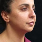 Rhinoplasty Before & After Patient #11951