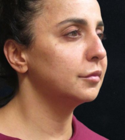 Rhinoplasty Before & After Patient #11951