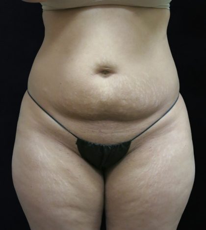Liposuction Before & After Patient #11540