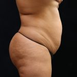 Liposuction Before & After Patient #11549