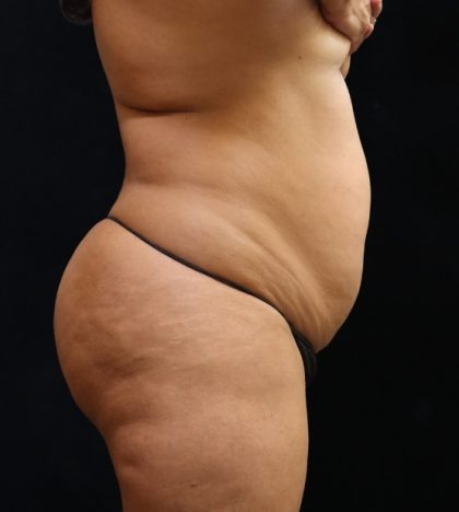 Liposuction Before & After Patient #11549