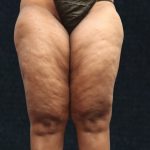 Liposuction Before & After Patient #11550