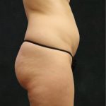 Liposuction Before & After Patient #11552