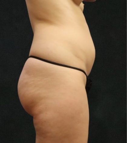Liposuction Before & After Patient #11552