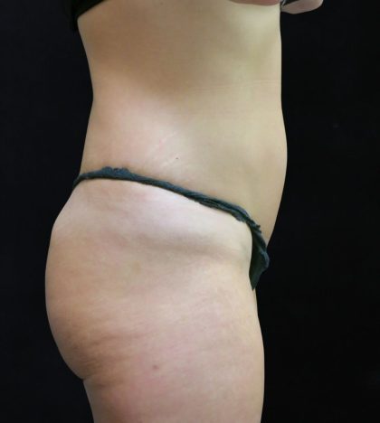 Liposuction Before & After Patient #11554