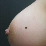 Inverted Nipple Correction Before & After Patient #11633