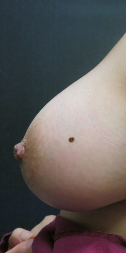Inverted Nipple Correction Before & After Patient #11633