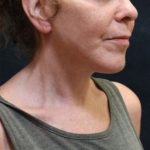 Facelift Before & After Patient #11659