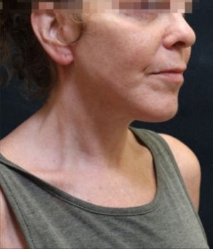 Facelift Before & After Patient #11659