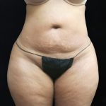 Liposuction Before & After Patient #11540