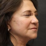 Facelift Before & After Patient #11660
