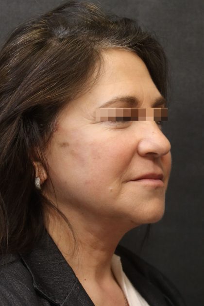 Facelift Before & After Patient #11660