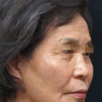 Facelift Before & After Patient #11664