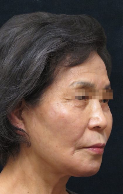 Facelift Before & After Patient #11664