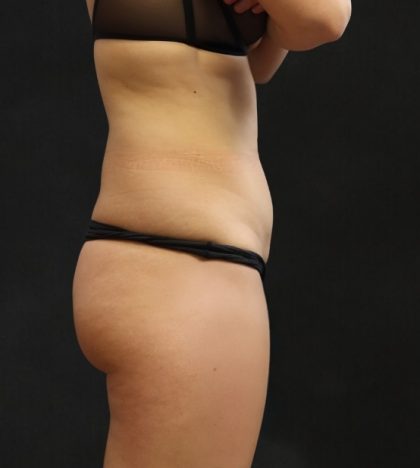 Liposuction Before & After Patient #11543