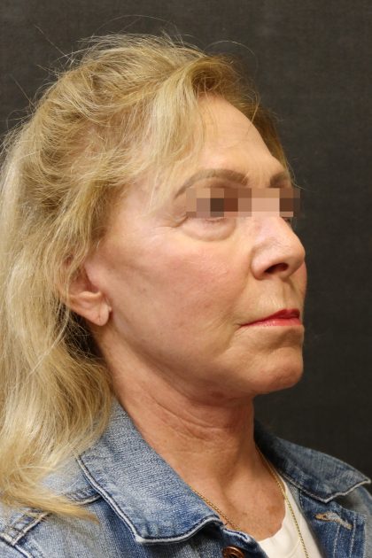Facelift Before & After Patient #11662