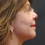 Facelift Before & After Patient #11663