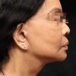 Facelift Before & After Patient #11668
