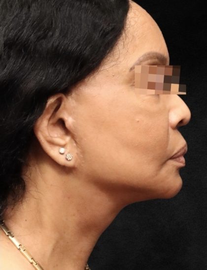 Facelift Before & After Patient #11668