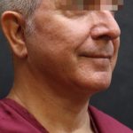 Facelift Before & After Patient #11669