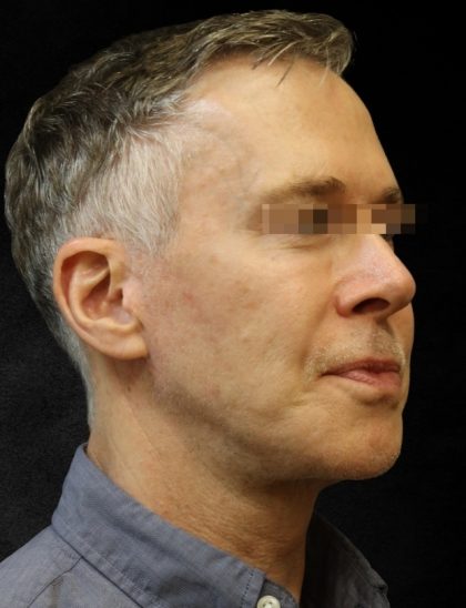 Levinelift Before & After Patient #11789