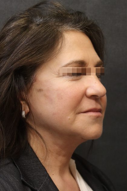 Levinelift Before & After Patient #11788