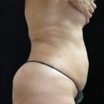 Liposuction Before & After Patient #11545