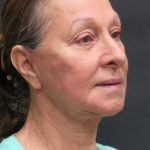 Levinelift Before & After Patient #11793