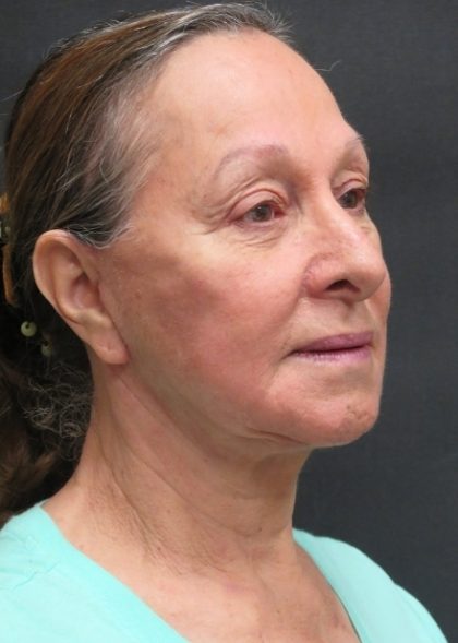 Levinelift Before & After Patient #11793
