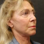 Levinelift Before & After Patient #11790