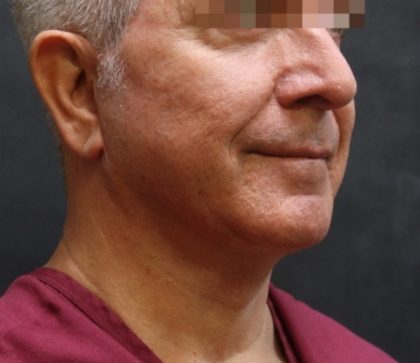 Levinelift Before & After Patient #11824